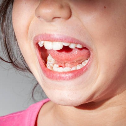 Ceramic Crowns in Riyadh 2 crowded teeth treatment in saudi arabia