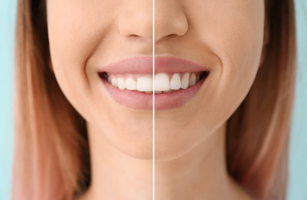 Gum Contouring in Riyadh 3 gum contouring before and after