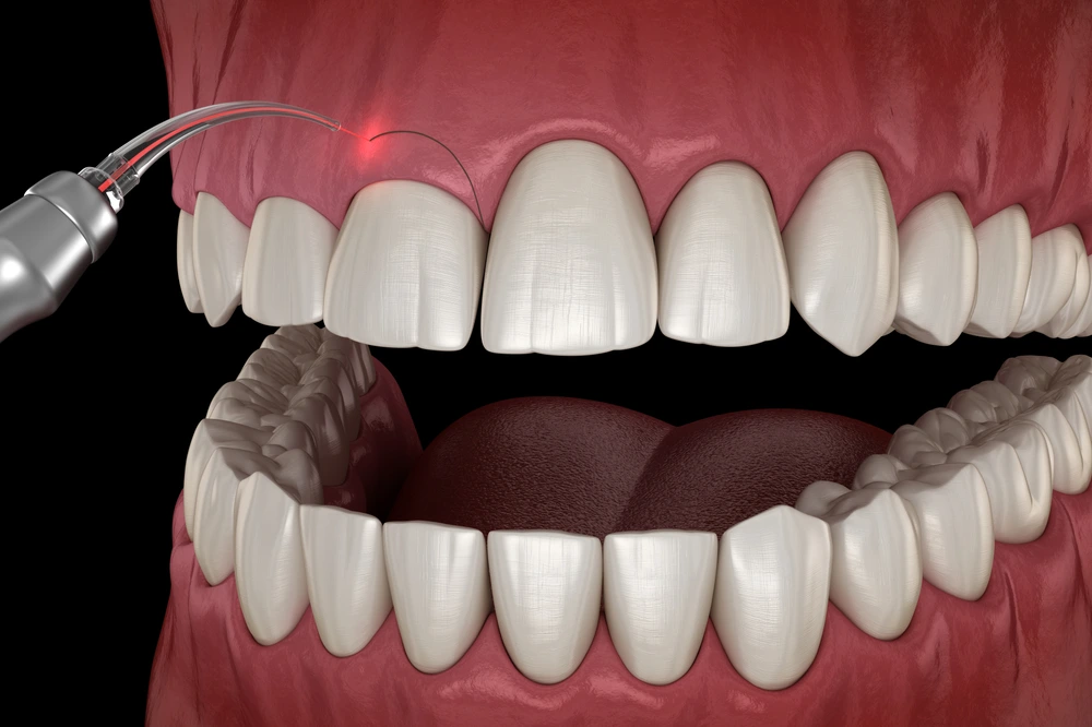 Gum Contouring in Riyadh 1 gum contouring how it works