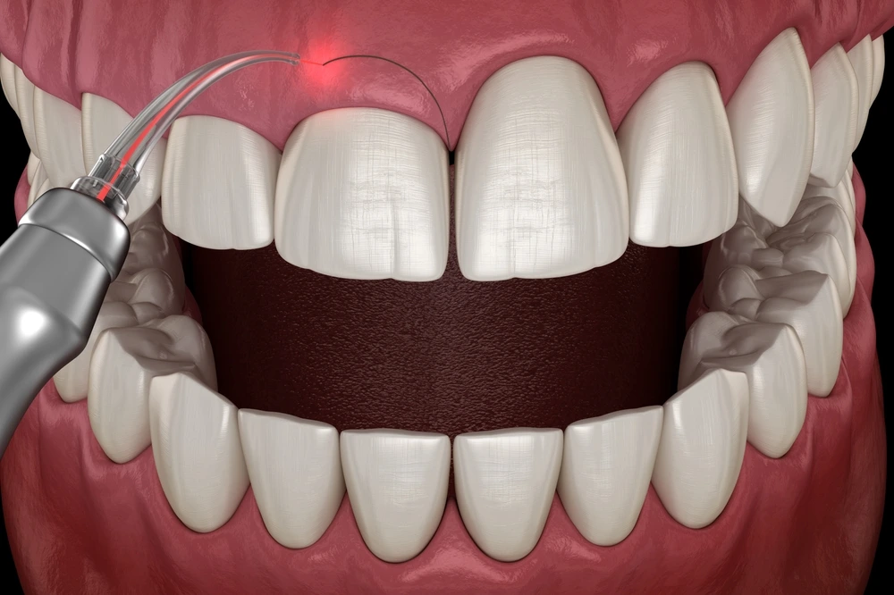 Gum Contouring in Riyadh 2 gum contouring procedure