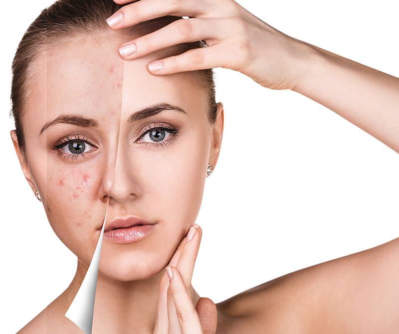 Deep Cleansing Facial in Riyadh | Saudi Arabia 2 deep cleansing facial before and after