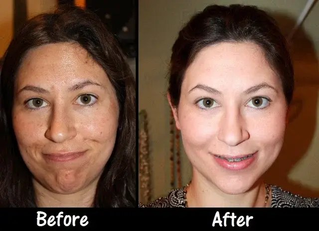 TCA Peel before after