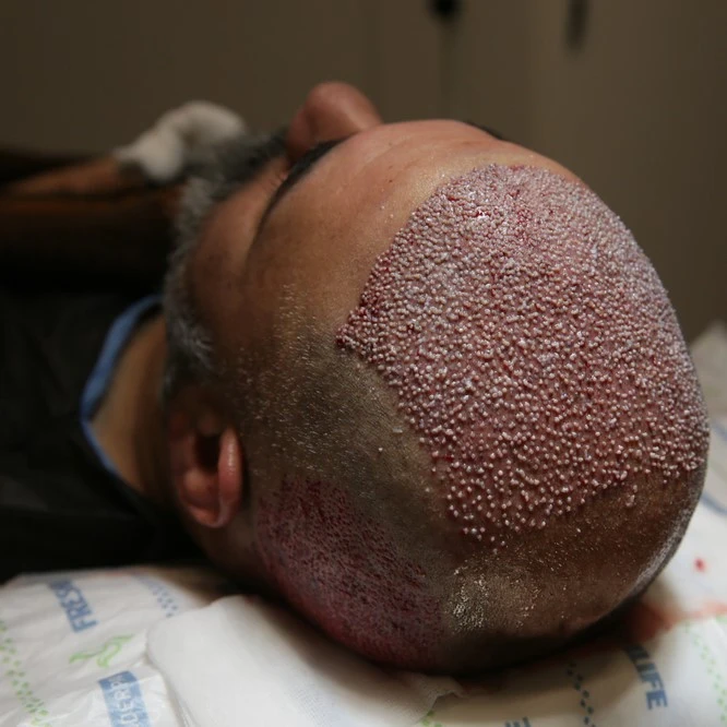Scarless Hair Transplant in Riyadh 2 FUE hair transplant procedure