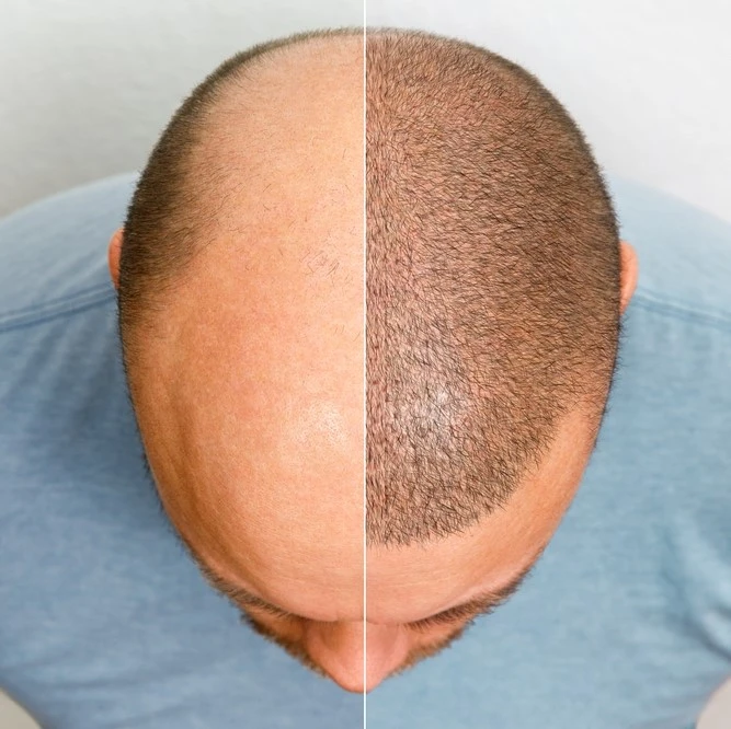 Scarless Hair Transplant in Riyadh 5 FUE hair transplant results