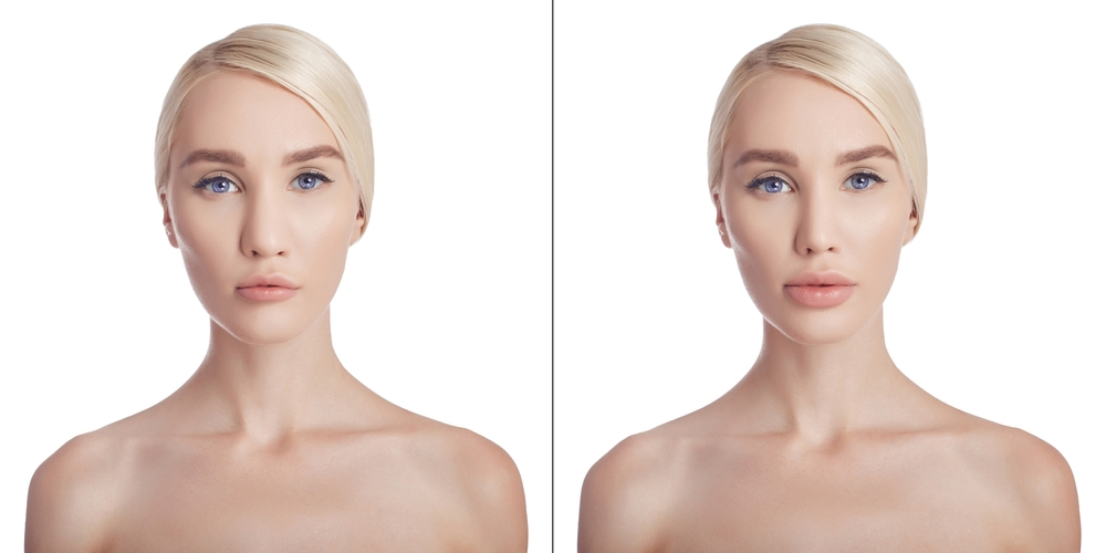 Bullhorn Lip Lift in Riyadh | Saudi Arabia 3 bullhorn lip lift before and after