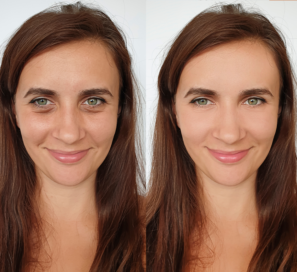 Eye Bag Removal in Riyadh | Saudi Arabia 3 eye bag removal before and after