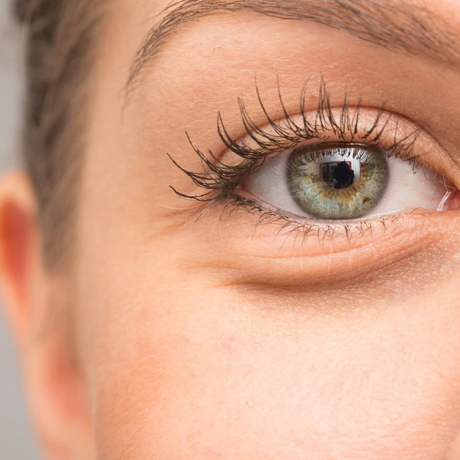 Dark Circles Treatment in Riyadh | Saudi Arabia 2 eye bag removal in saudi arabia