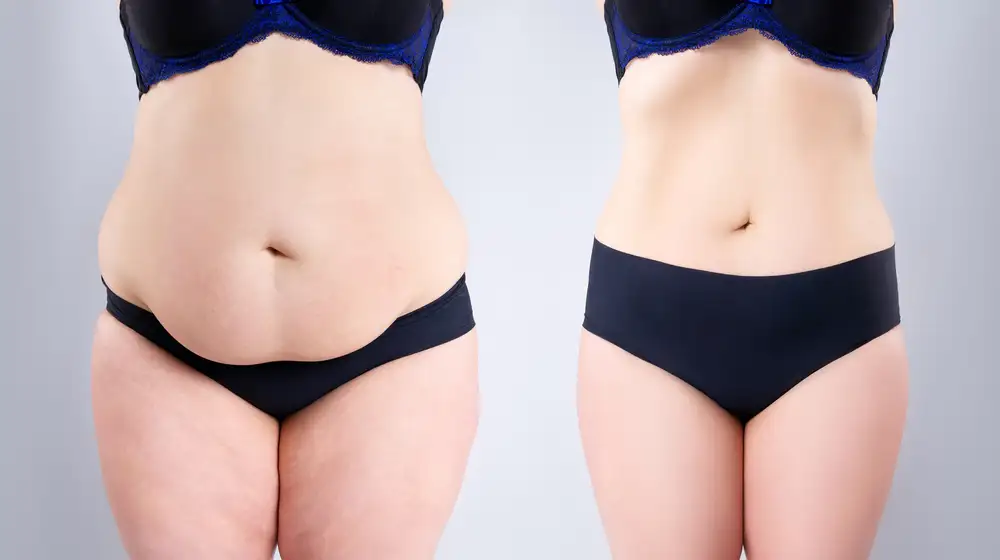 Liposuction in Riyadh 1 liposuction in saudi arabia results