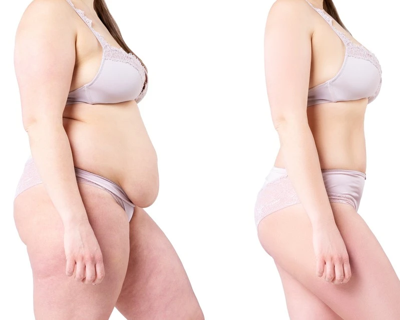Tummy Tuck in Riyadh 2 tummy tuck before and after