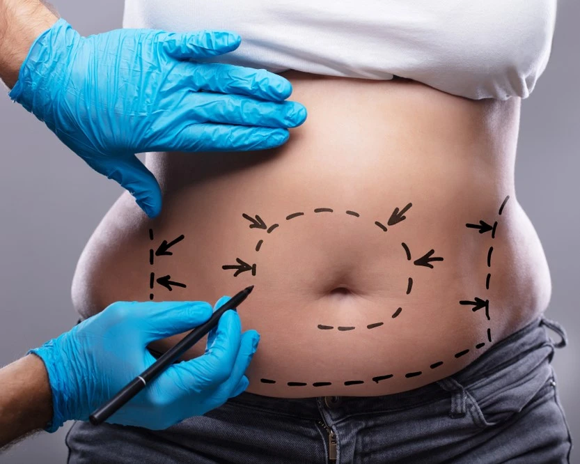 Tummy Tuck in Riyadh 1 tummy tuck how it works