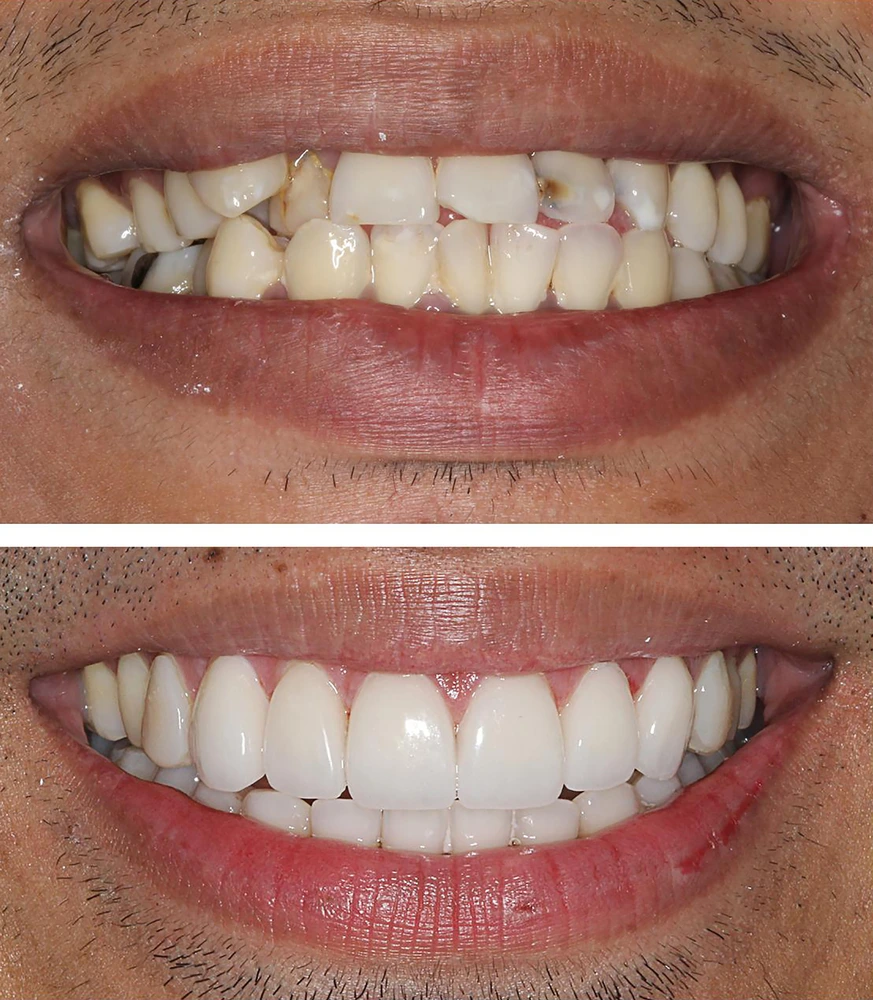 Composite Veneers in Riyadh | Saudi Arabia 3 E Max Veneers before and after