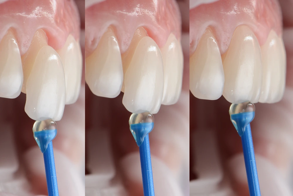 Composite Veneers in Riyadh | Saudi Arabia 2 E Max Veneers procedure