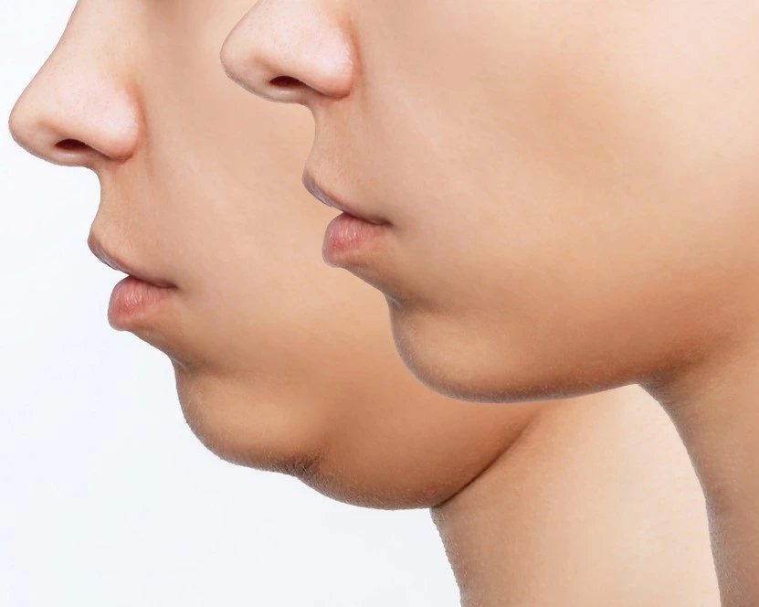 Chin Reduction in Riyadh | Saudi Arabia 5 chin reduction before and after 1