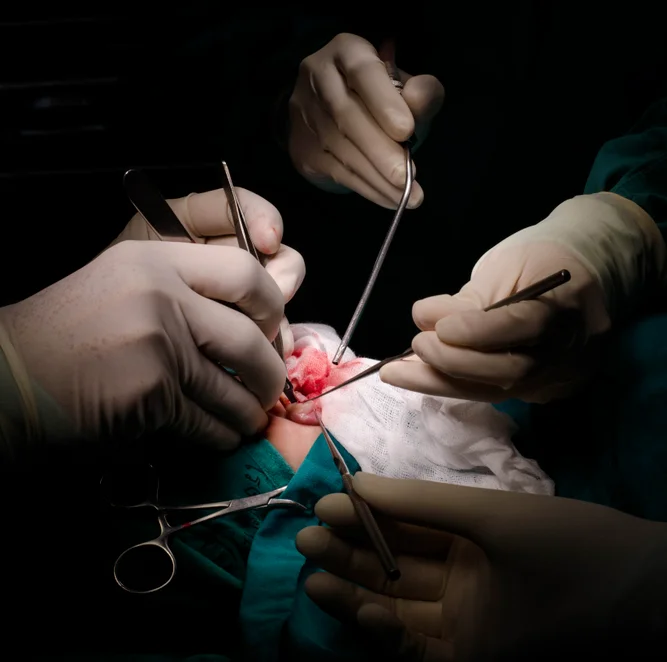 Cleft Lip Surgery in Riyadh | Saudi Arabia 5 cleft lip surgery procedure