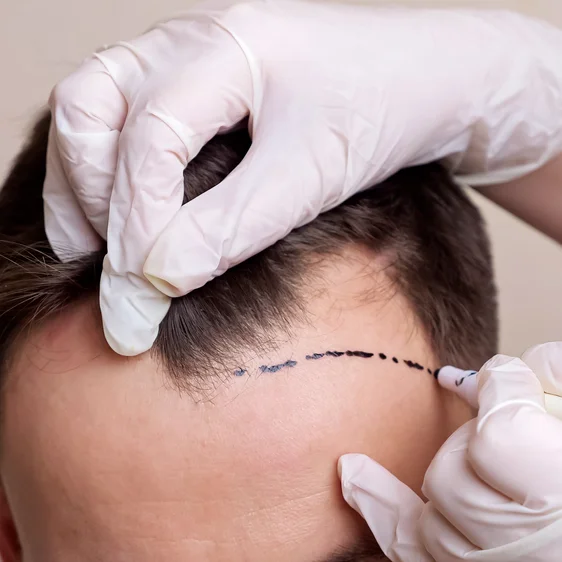 Scarless Hair Transplant in Riyadh 1 hair transplant how it works
