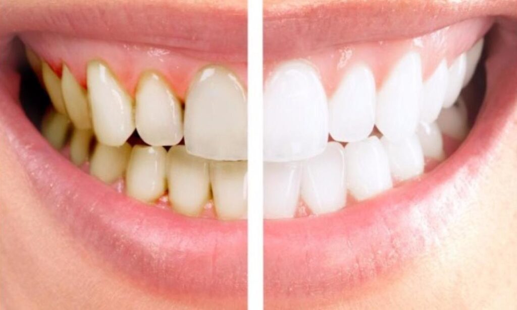 Teeth Scaling and Polishing in Riyadh 1 teeth scaling before and after