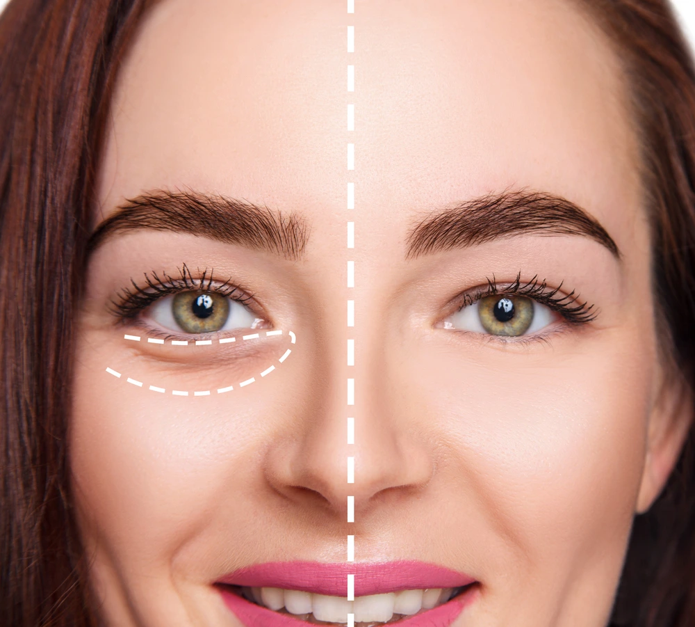 Under Eye Fillers in Riyadh 2 under eye fillers results
