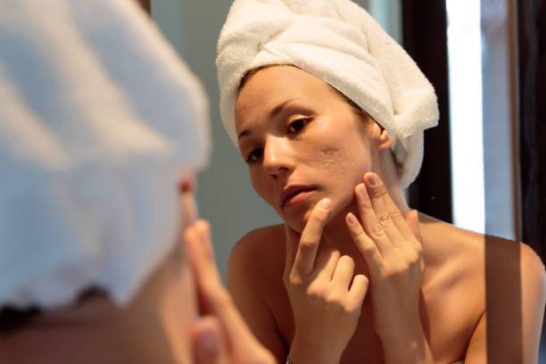 Subcision Treatment for Acne Scars in Riyadh 1 Subcision Treatment for Acne Scars how it works