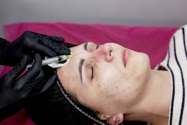 Subcision Treatment for Acne Scars in Riyadh 2 Subcision Treatment for Acne Scars procedure