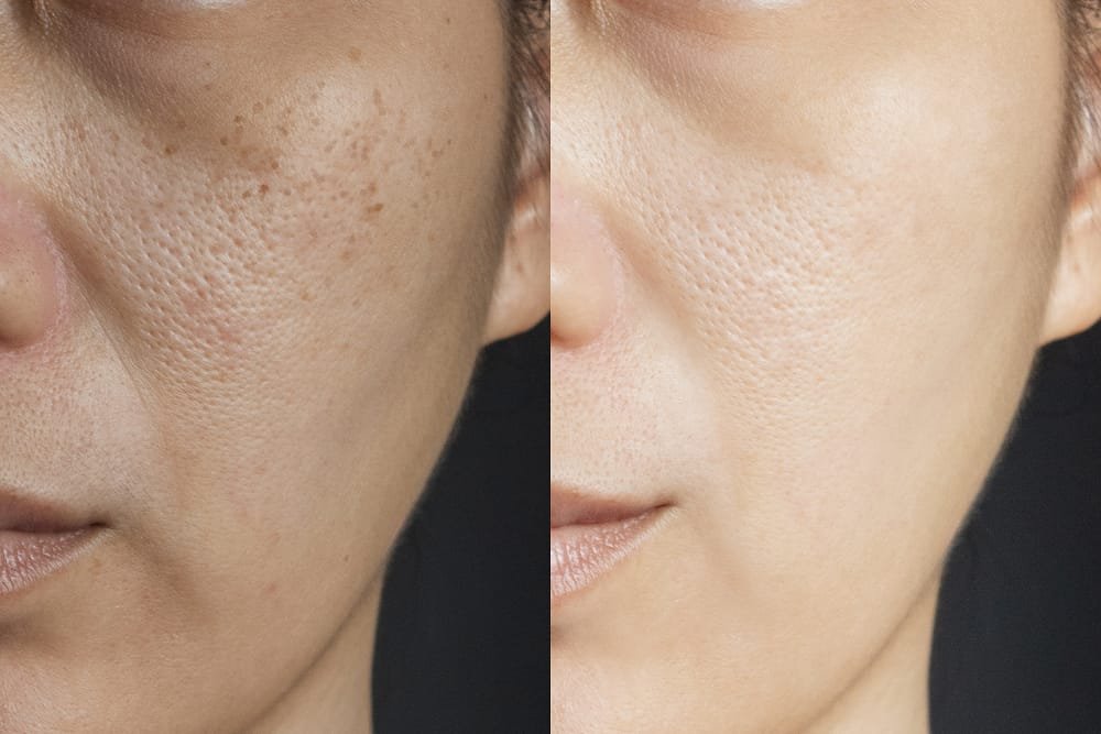 Superficial Chemical Peels in Riyadh 3 Superficial chemical peel before and after