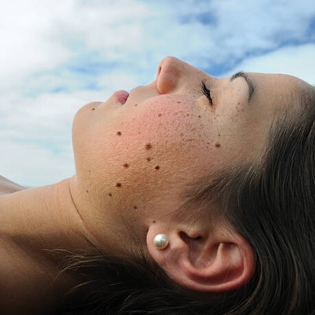 Warts Removal in Riyadh 4 mole removal in saudi arabia