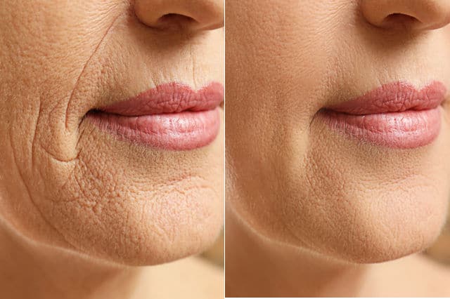 Plasma Pen Treatment in Riyadh 3 plasma pen before and after