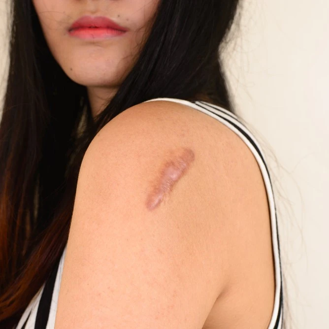 Warts Removal in Riyadh 3 skin lesions removal in saudi arabia