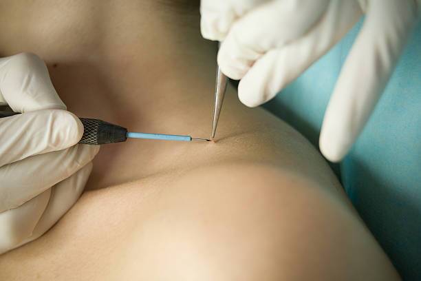 Warts Removal in Riyadh 2 warts removal procedure