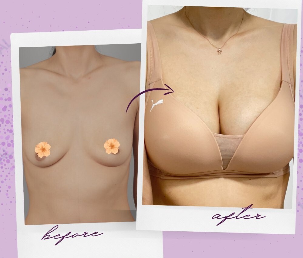 Mentor Breast Implant in Riyadh 3 Mentor Breast Implant Before and After