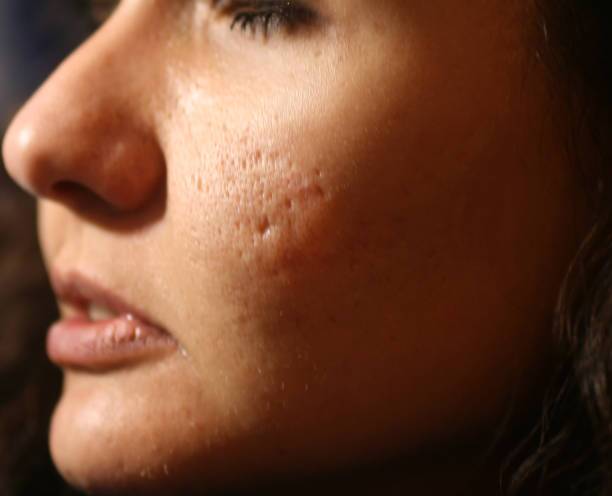 Freckles and Blemishes Treatment in Riyadh 3 large pores treatment in riyadh