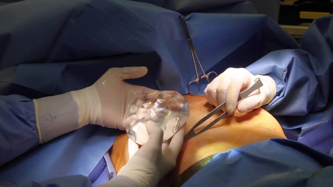 Mentor Breast Implant in Riyadh 2 mentor breast implant procedure