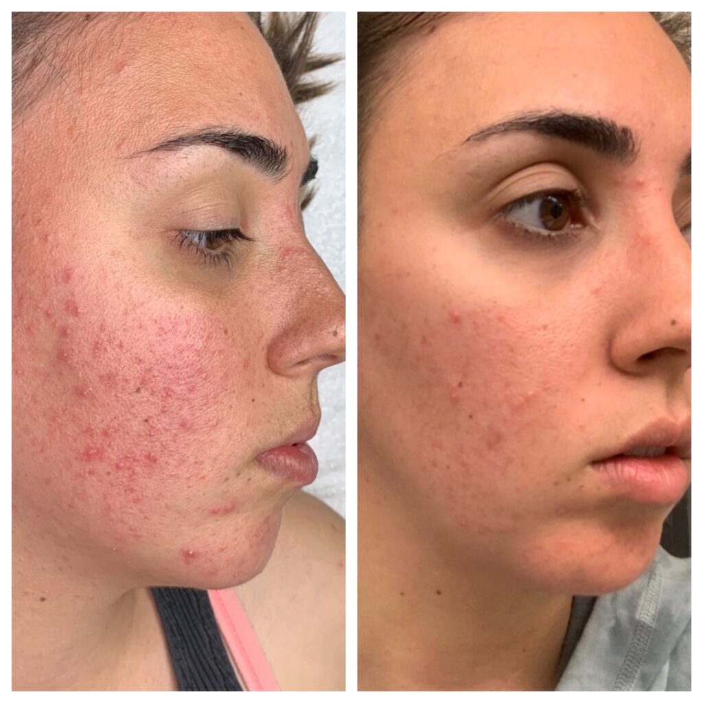 DMK Enzyme Therapy in Riyadh 3 dmk enzyme therapy before and after