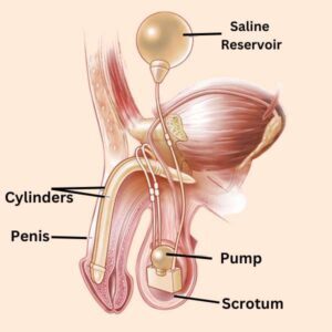Inflatable Penile Implant