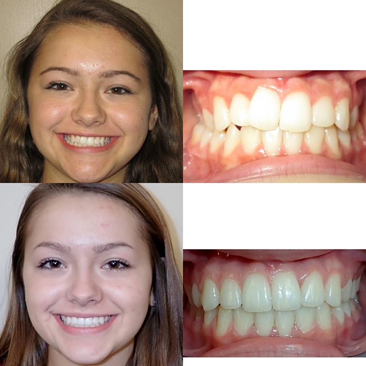 Dental Braces in Riyadh | Saudi Arabia 1 dental braces before after