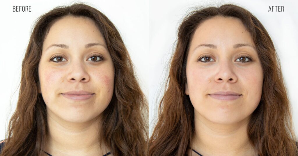 Best HydraFacial in Riyadh 3 hydrafacial treatment results before and after