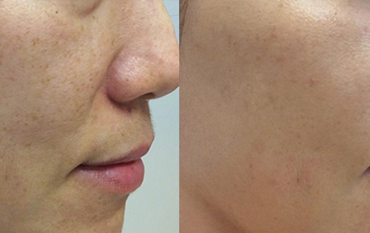 Pico Laser Treatment in Riyadh 2 pico laser before after