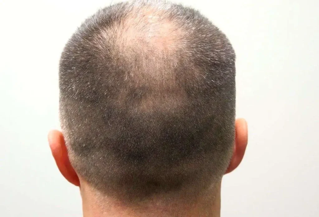 Hair Transplant Cost in Riyadh 4 Best Hair Transplant Surgeon in Riyadh