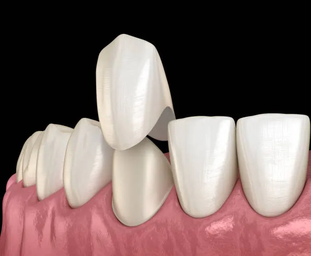 Composite Veneers in Riyadh | Saudi Arabia 6 composite veneers in riyadh