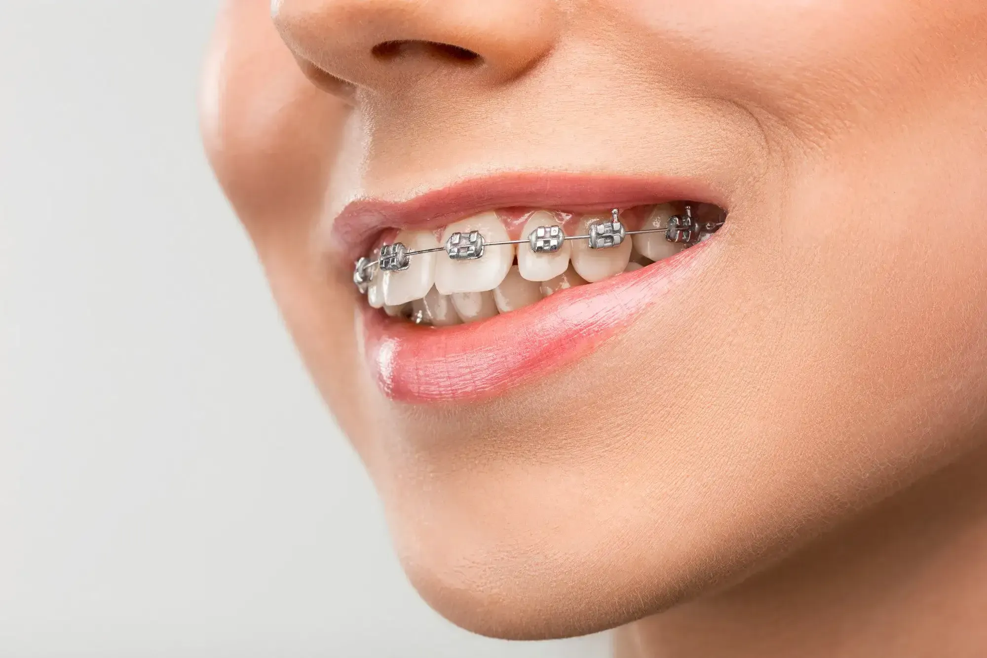 Dental Braces in Riyadh | Saudi Arabia 6 dental braces in riyadh