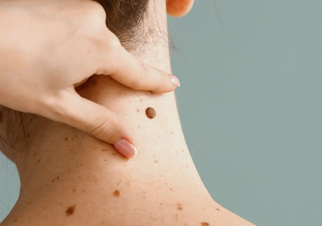 Warts Removal in Riyadh 5 Skin Wart Removal Cost in Riyadh