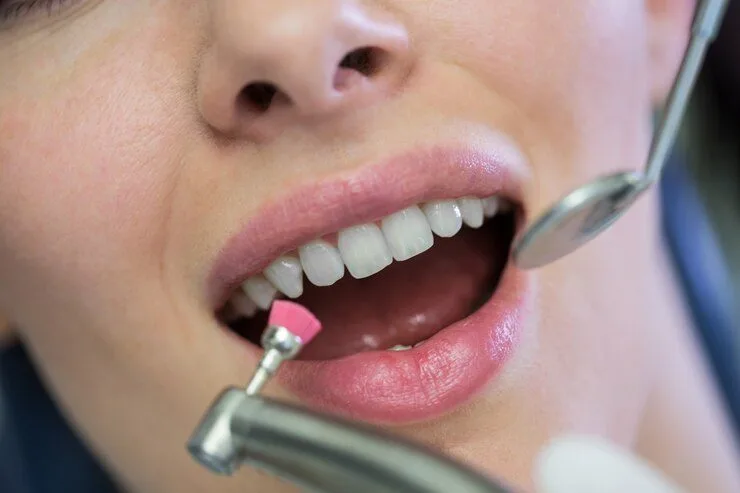 Teeth Scaling and Polishing in Riyadh 4 Scaling And Polishing Cost in Riyadh