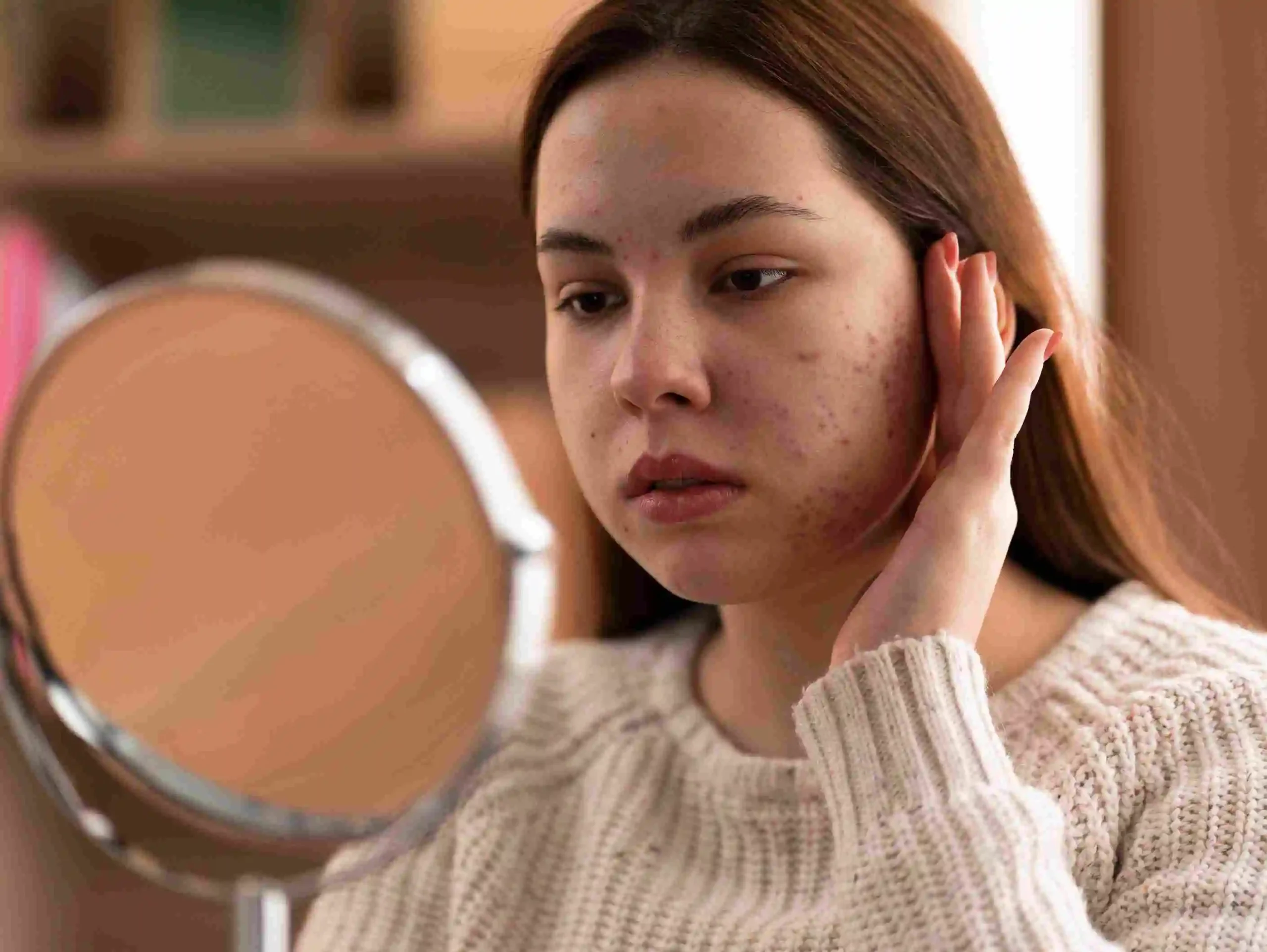Laser Acne Treatment in Riyadh 4 Pros And Cons Of Laser Acne Scar Is It Right For You (2)