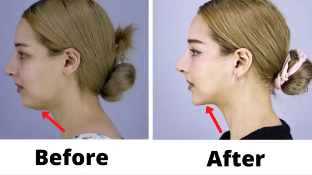 Fat Melting Injections in Riyadh | Saudi Arabia 1 Fat Melting Injections Results in Riyadh before and after treatment
