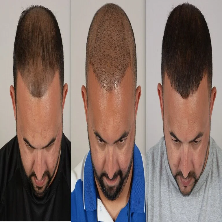 Follicular Unit Extraction (FUE) Hair Transplant in riyadh before & after result