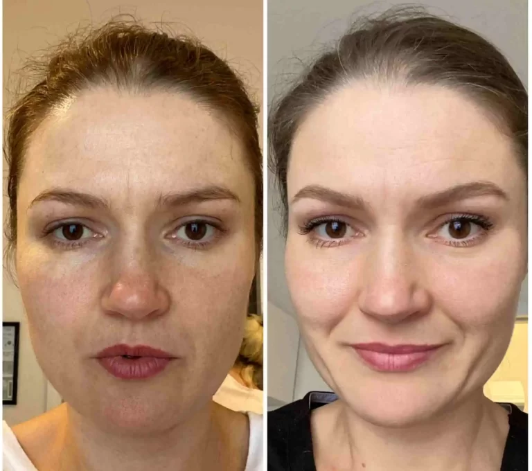 Bio-Revitalization Treatment in Riyadh | Saudi Arabia 3 Glycolic Peel before after in Riyadh