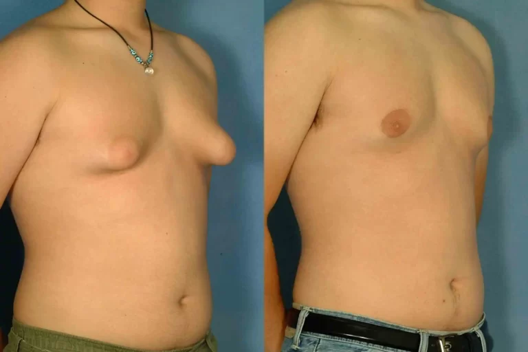 Gynecomastia Surgery in Riyadh 1 Gynecomastia Surgery before after results in Riyadh