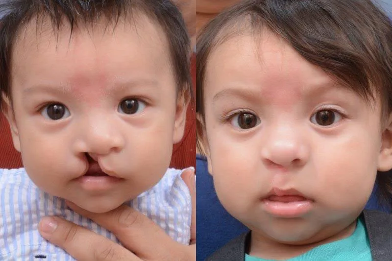 Cleft Lip Surgery in Riyadh | Saudi Arabia 4 cleft lip surgery before after in riyadh