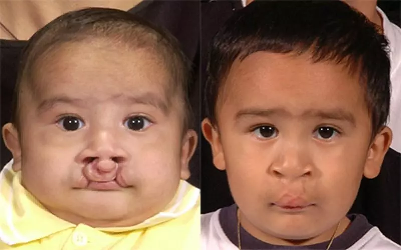 Cleft Lip Surgery in Riyadh | Saudi Arabia 3 cleft lip surgery before after results in riyadh