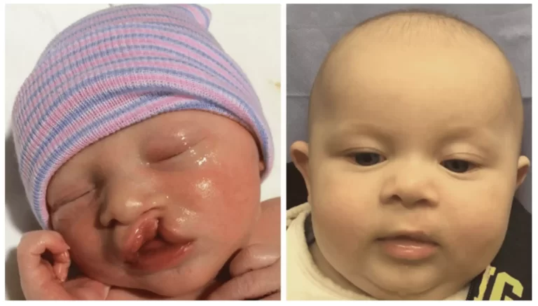 Cleft Lip Surgery in Riyadh | Saudi Arabia 1 cleft lip surgery before after results riyadh saudi