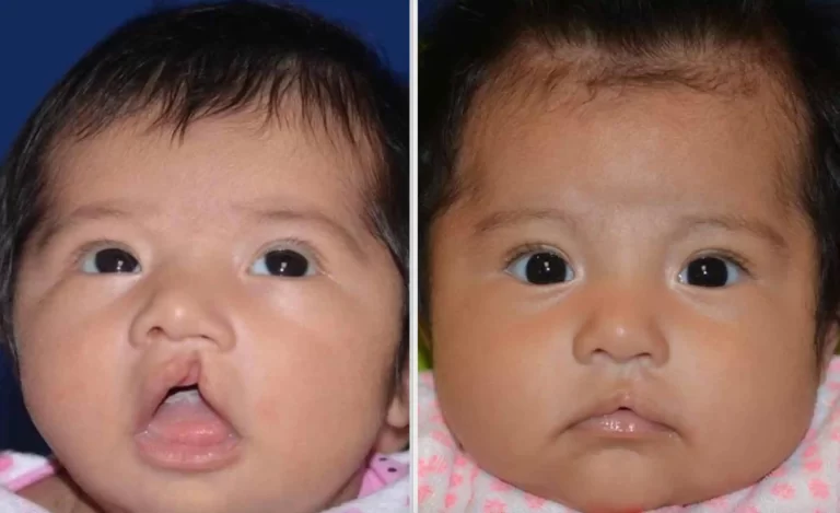 Cleft Lip Surgery in Riyadh | Saudi Arabia 2 cleft lip surgery before after results riyadh